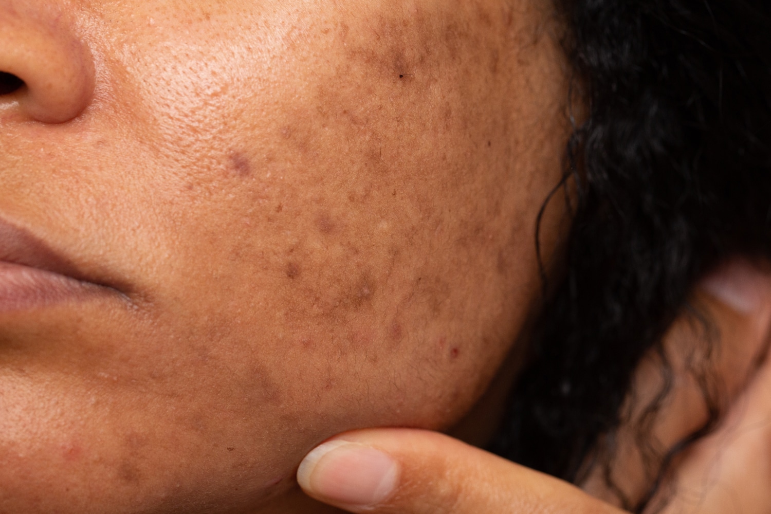 Joue d'une femme présentant du melasma ou taches pigmentaires.